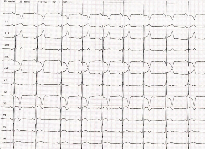 ECG CMH 2.png