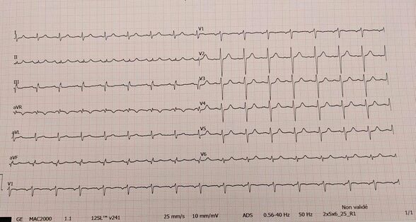 ECG et embolie pulmonaire — Uness Cardiologie