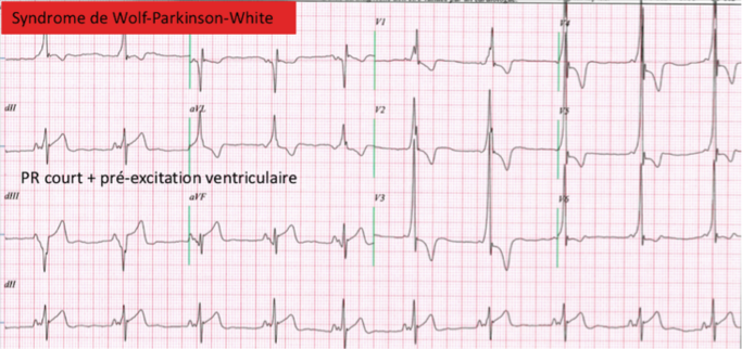 Syndrome de Wolff-Parkinson-White.