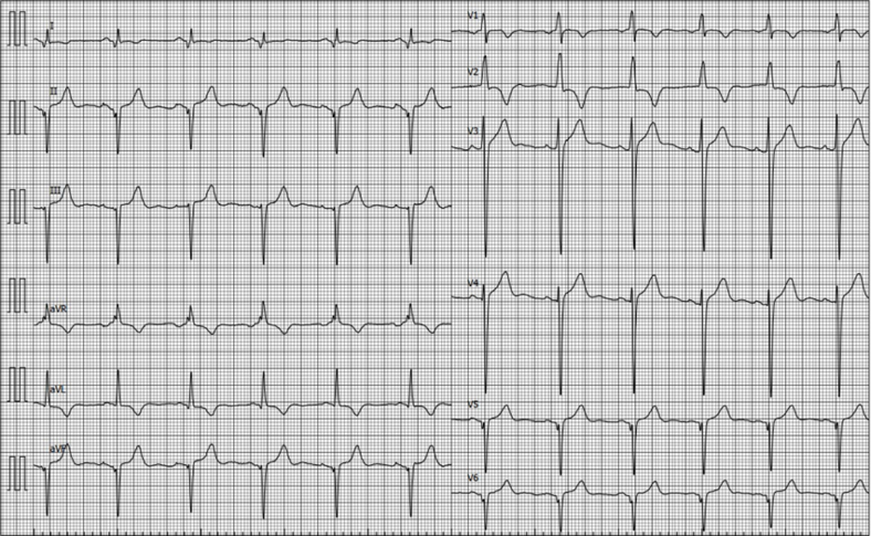 ECG CMH 1.png