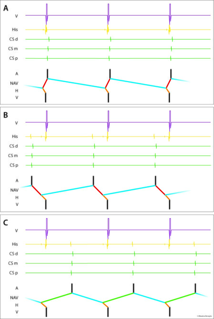 Tachycardie Par R entr e Intra nodale Uness Cardiologie