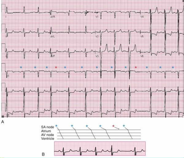 Dysfonction sinusale / bloc sinoatrial — Uness Cardiologie — free download