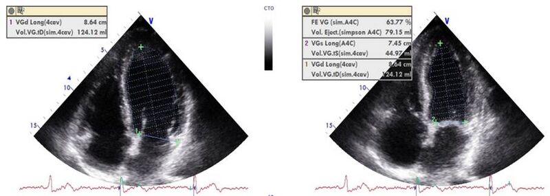 Fichier:Echographie en diastole et systole.jpg