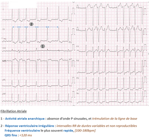 Fibrillation atriale .png