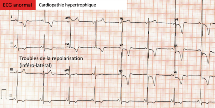 Aspect compatible avec cardiomyopathie hypertrophique.