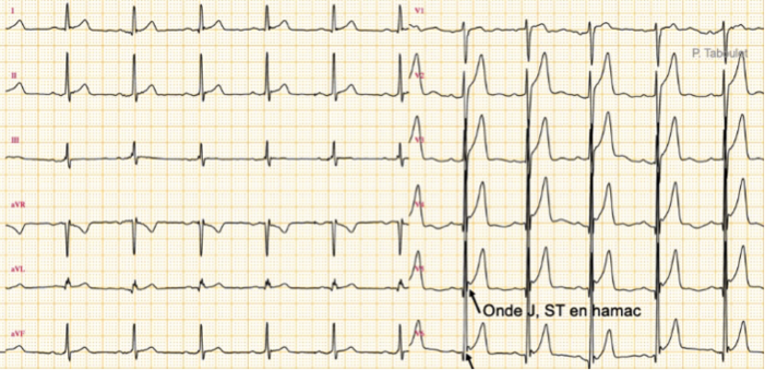Syndrome de repolarisation précoce. [1]