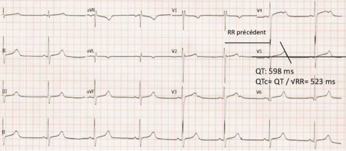 Syndrome du QT long.
