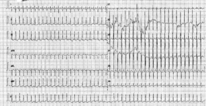 Tachycardie jonctionnelle chez un nouveau-né