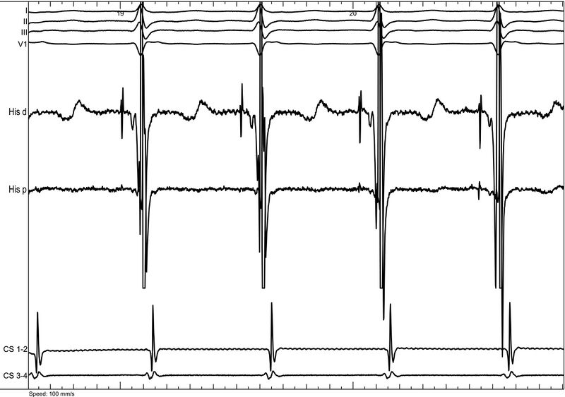 Fichier:Figure 14 - AVNRT with His.jpg
