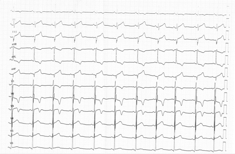 ECG CMH 3.png