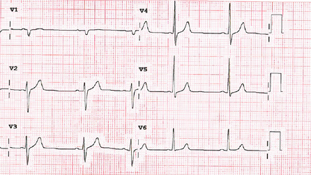 QRS précordium.png